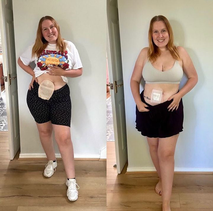Stoma Bag Misconception